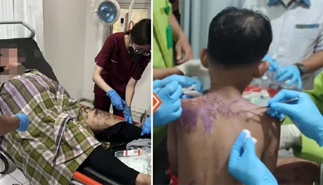 Ibu dan Anak di Sukabumi Disiram Air Keras saat Naik Motor