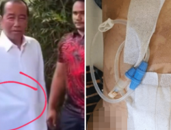 Tak Hanya Wajah, Perut Jokowi Juga Disorot Saat Acara Ulang Tahun, Dokter Tifa Duga Itu Alat CAPD