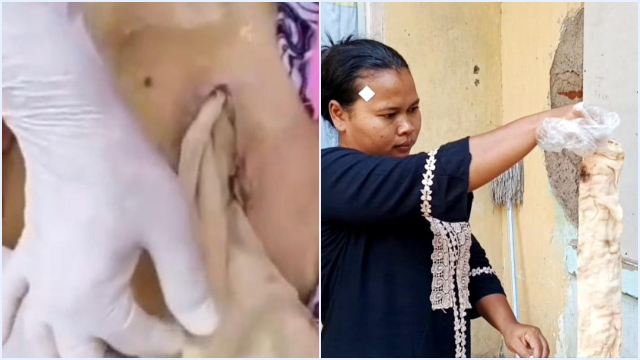 Lansia di Bekasi Meninggal usai Operasi Bisul, Perut Terisi Kasa Tanpa Dijahit, RS Klaim Sesuai SOP