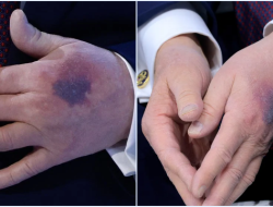 Memar di Tangan Donald Trump di Davos: Penyebab, Kaitan Aspirin, dan Penjelasan Dokter
