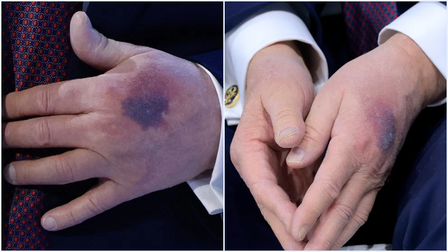 Memar di Tangan Donald Trump di Davos: Penyebab, Kaitan Aspirin, dan Penjelasan Dokter
